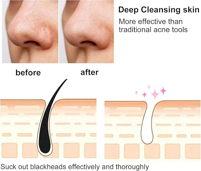 4 in 1 Blackhead Remover – Pore Vacuum Suction Tool