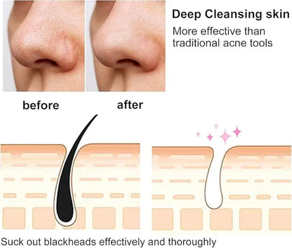 4 in 1 Blackhead Remover – Pore Vacuum Suction Tool